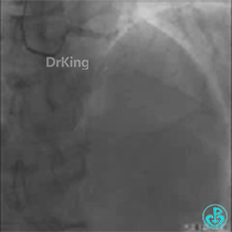 为什么要用到微导管KDLC双腔微导管在反转导丝中的应用_https://www.jmylbn.com_新闻资讯_第1张