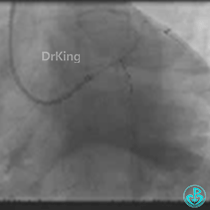 为什么要用到微导管KDLC双腔微导管在反转导丝中的应用_https://www.jmylbn.com_新闻资讯_第12张