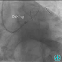 为什么要用到微导管KDLC双腔微导管在反转导丝中的应用_https://www.jmylbn.com_新闻资讯_第10张