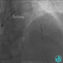 为什么要用到微导管KDLC双腔微导管在反转导丝中的应用_https://www.jmylbn.com_新闻资讯_第5张