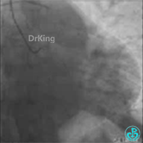 为什么要用到微导管KDLC双腔微导管在反转导丝中的应用_https://www.jmylbn.com_新闻资讯_第3张