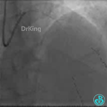 为什么要用到微导管KDLC双腔微导管在反转导丝中的应用_https://www.jmylbn.com_新闻资讯_第8张