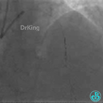 为什么要用到微导管KDLC双腔微导管在反转导丝中的应用_https://www.jmylbn.com_新闻资讯_第6张