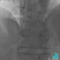 为什么要用到微导管KDLC双腔微导管在反转导丝中的应用_https://www.jmylbn.com_新闻资讯_第2张