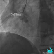 为什么要用到微导管KDLC双腔微导管在反转导丝中的应用_https://www.jmylbn.com_新闻资讯_第4张