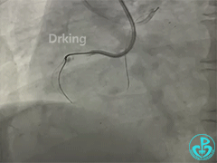 导丝怎么扩收藏：器械难以通过的CTO病变之技术图谱_https://www.jmylbn.com_新闻资讯_第14张