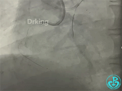 导丝怎么扩收藏：器械难以通过的CTO病变之技术图谱_https://www.jmylbn.com_新闻资讯_第16张