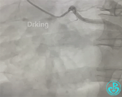 导丝怎么扩收藏：器械难以通过的CTO病变之技术图谱_https://www.jmylbn.com_新闻资讯_第5张