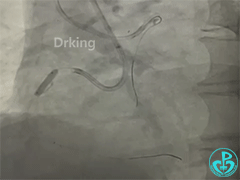 导丝怎么扩收藏：器械难以通过的CTO病变之技术图谱_https://www.jmylbn.com_新闻资讯_第29张