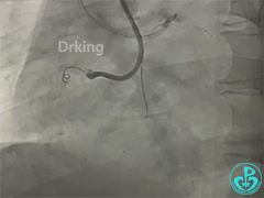 导丝怎么扩收藏：器械难以通过的CTO病变之技术图谱_https://www.jmylbn.com_新闻资讯_第10张