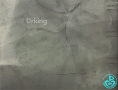 导丝怎么扩收藏：器械难以通过的CTO病变之技术图谱_https://www.jmylbn.com_新闻资讯_第23张