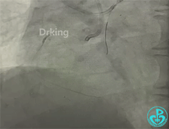 导丝怎么扩收藏：器械难以通过的CTO病变之技术图谱_https://www.jmylbn.com_新闻资讯_第17张