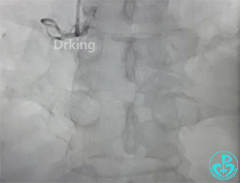 导丝怎么扩收藏：器械难以通过的CTO病变之技术图谱_https://www.jmylbn.com_新闻资讯_第7张