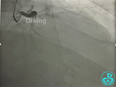 导丝怎么扩收藏：器械难以通过的CTO病变之技术图谱_https://www.jmylbn.com_新闻资讯_第2张