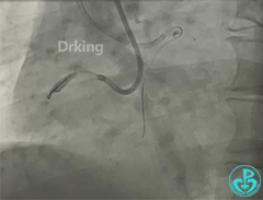 导丝怎么扩收藏：器械难以通过的CTO病变之技术图谱_https://www.jmylbn.com_新闻资讯_第12张