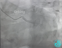 导丝怎么扩收藏：器械难以通过的CTO病变之技术图谱_https://www.jmylbn.com_新闻资讯_第4张