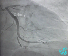 导丝怎么扩收藏：器械难以通过的CTO病变之技术图谱_https://www.jmylbn.com_新闻资讯_第3张