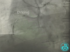 导丝怎么扩收藏：器械难以通过的CTO病变之技术图谱_https://www.jmylbn.com_新闻资讯_第22张