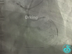 导丝怎么扩收藏：器械难以通过的CTO病变之技术图谱_https://www.jmylbn.com_新闻资讯_第21张