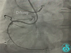 导丝怎么扩收藏：器械难以通过的CTO病变之技术图谱_https://www.jmylbn.com_新闻资讯_第27张