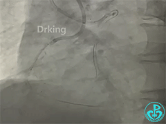 导丝怎么扩收藏：器械难以通过的CTO病变之技术图谱_https://www.jmylbn.com_新闻资讯_第28张