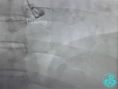 导丝怎么扩收藏：器械难以通过的CTO病变之技术图谱_https://www.jmylbn.com_新闻资讯_第8张