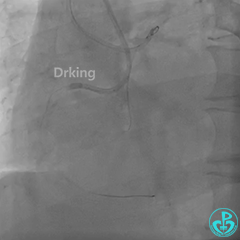 导丝怎么扩收藏：器械难以通过的CTO病变之技术图谱_https://www.jmylbn.com_新闻资讯_第24张