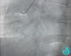 导丝怎么扩收藏：器械难以通过的CTO病变之技术图谱_https://www.jmylbn.com_新闻资讯_第6张