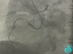 导丝怎么扩收藏：器械难以通过的CTO病变之技术图谱_https://www.jmylbn.com_新闻资讯_第15张