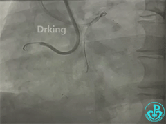 导丝怎么扩收藏：器械难以通过的CTO病变之技术图谱_https://www.jmylbn.com_新闻资讯_第11张