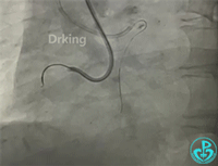 导丝怎么扩收藏：器械难以通过的CTO病变之技术图谱_https://www.jmylbn.com_新闻资讯_第9张