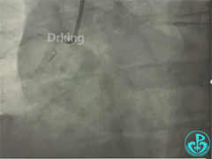 导丝怎么扩收藏：器械难以通过的CTO病变之技术图谱_https://www.jmylbn.com_新闻资讯_第30张