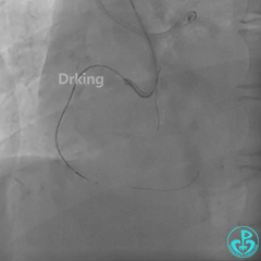 导丝怎么扩收藏：器械难以通过的CTO病变之技术图谱_https://www.jmylbn.com_新闻资讯_第20张