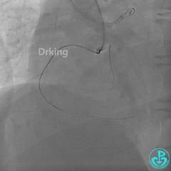 导丝怎么扩收藏：器械难以通过的CTO病变之技术图谱_https://www.jmylbn.com_新闻资讯_第19张