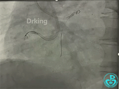 导丝怎么扩收藏：器械难以通过的CTO病变之技术图谱_https://www.jmylbn.com_新闻资讯_第13张