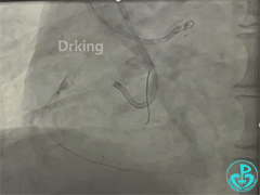 导丝怎么扩收藏：器械难以通过的CTO病变之技术图谱_https://www.jmylbn.com_新闻资讯_第18张
