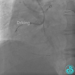 导丝怎么扩收藏：器械难以通过的CTO病变之技术图谱_https://www.jmylbn.com_新闻资讯_第25张