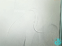 泥鳅导丝怎么用泥鳅导丝致纵隔血肿，少见但很危险_https://www.jmylbn.com_新闻资讯_第5张