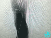 泥鳅导丝怎么用泥鳅导丝致纵隔血肿，少见但很危险_https://www.jmylbn.com_新闻资讯_第2张