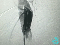 泥鳅导丝怎么用泥鳅导丝致纵隔血肿，少见但很危险_https://www.jmylbn.com_新闻资讯_第3张