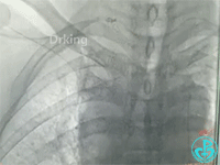 泥鳅导丝怎么用泥鳅导丝致纵隔血肿，少见但很危险_https://www.jmylbn.com_新闻资讯_第9张