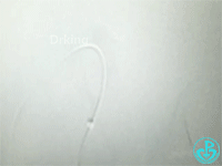 泥鳅导丝怎么用泥鳅导丝致纵隔血肿，少见但很危险_https://www.jmylbn.com_新闻资讯_第8张