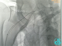 泥鳅导丝怎么用泥鳅导丝致纵隔血肿，少见但很危险_https://www.jmylbn.com_新闻资讯_第4张