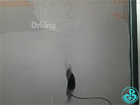 泥鳅导丝怎么用泥鳅导丝致纵隔血肿，少见但很危险_https://www.jmylbn.com_新闻资讯_第1张