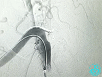 泥鳅导丝怎么用泥鳅导丝致纵隔血肿，少见但很危险_https://www.jmylbn.com_新闻资讯_第7张
