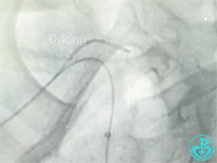 泥鳅导丝怎么用泥鳅导丝致纵隔血肿，少见但很危险_https://www.jmylbn.com_新闻资讯_第6张