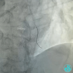 导丝怎么扩真怪！急性心梗前降支导丝通过顺利，球囊扩张后导丝移位很多！不在原来的血管腔！_https://www.jmylbn.com_新闻资讯_第8张