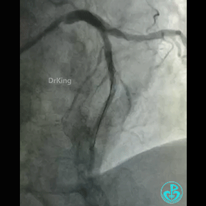 导丝怎么扩真怪！急性心梗前降支导丝通过顺利，球囊扩张后导丝移位很多！不在原来的血管腔！_https://www.jmylbn.com_新闻资讯_第13张