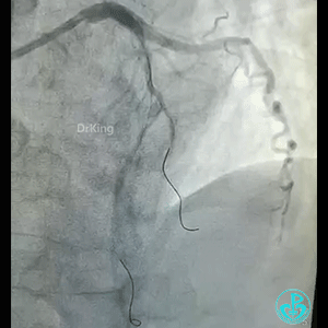 导丝怎么扩真怪！急性心梗前降支导丝通过顺利，球囊扩张后导丝移位很多！不在原来的血管腔！_https://www.jmylbn.com_新闻资讯_第6张