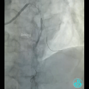 导丝怎么扩真怪！急性心梗前降支导丝通过顺利，球囊扩张后导丝移位很多！不在原来的血管腔！_https://www.jmylbn.com_新闻资讯_第10张